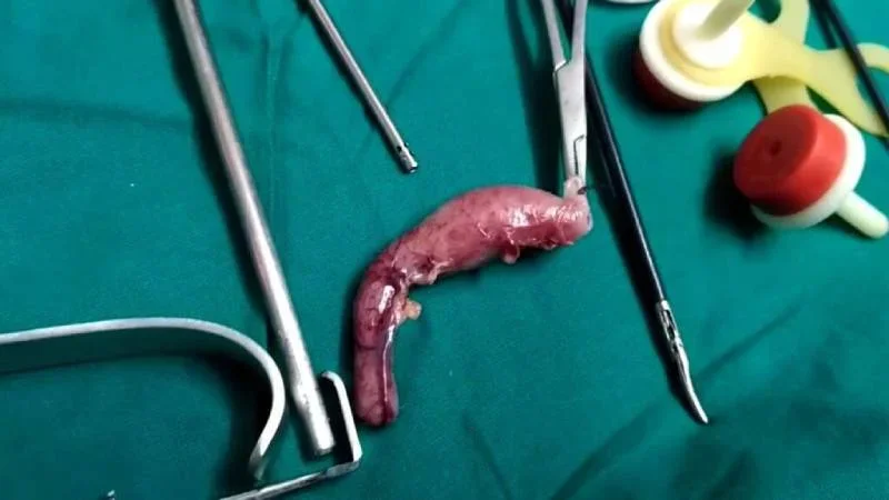 1786964427_appendectomy.webp