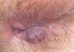 1786964619_hemorrhoids.webp