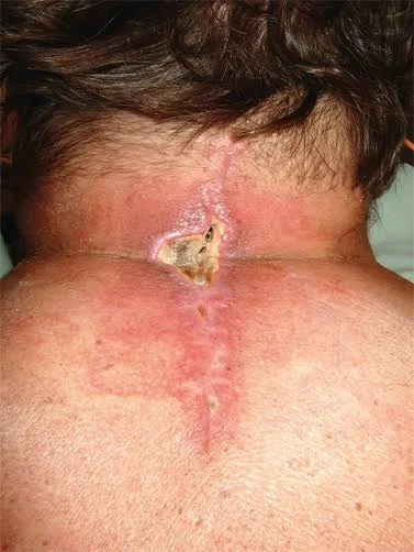 1786964916_surgicalsiteinfection.webp