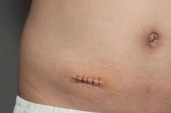suture removal timeing